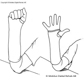 A forearm in cast placed with the elbow on a table. Fingers that clench and stretch.