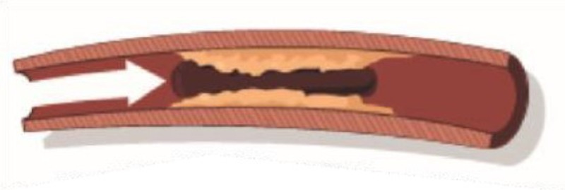 Blodpropp.