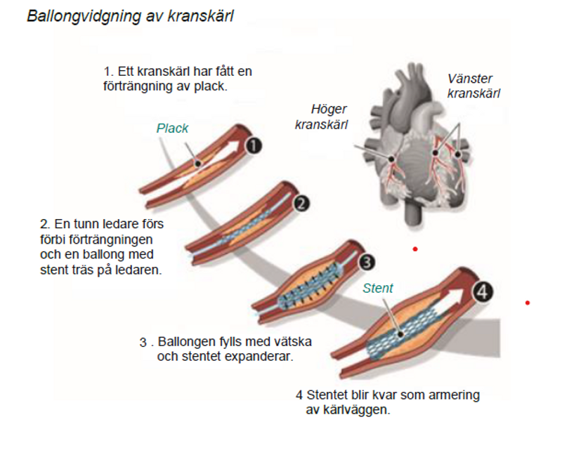 Ballongvidgning av kranskärl.