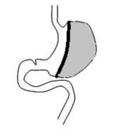En principskiss över en gastric sleeve-operation där magsäcken delas på längden så att utsidan delas av och tas bort.
